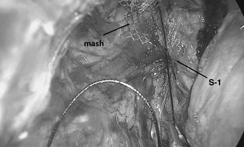 The Pure Extraperitoneal Approach for Sacrocolpopexy in Transvaginal Natural-Orifice Transluminal Endoscopic Surgery.