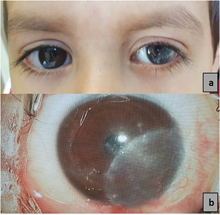 Lamellar Keratoplasty Using Microkeratome-Assisted Anterior Lamellar Graft in the Management of Deep Limbal Dermoid: A Case Report.