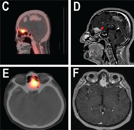 Meningioma Mimicking Bone Metastasis in Breast Cancer.