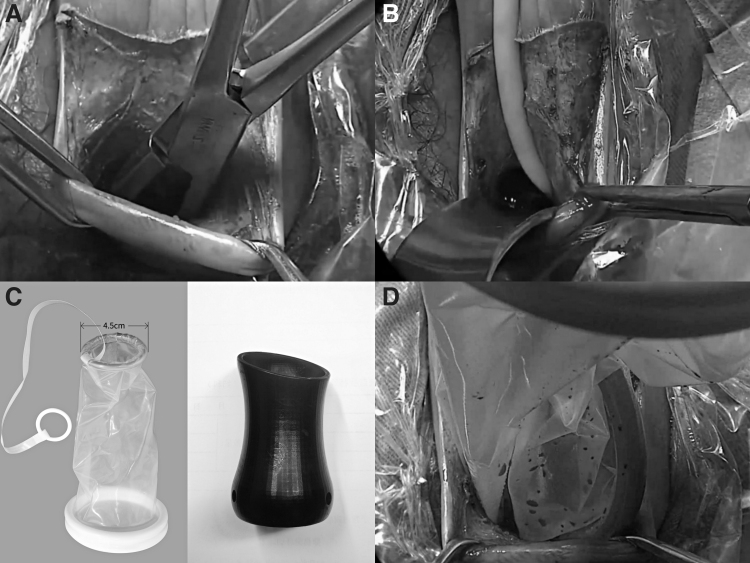 The Pure Extraperitoneal Approach for Sacrocolpopexy in Transvaginal Natural-Orifice Transluminal Endoscopic Surgery.