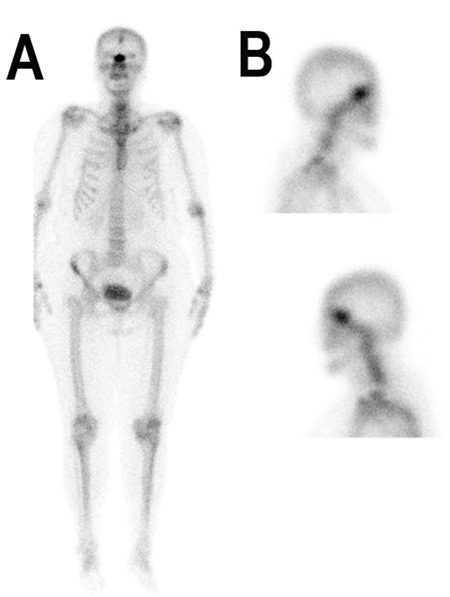 Meningioma Mimicking Bone Metastasis in Breast Cancer.