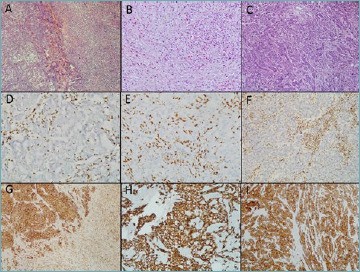 SMARCA4 as a support for the differential diagnosis of poorly differentiated lung carcinomas.