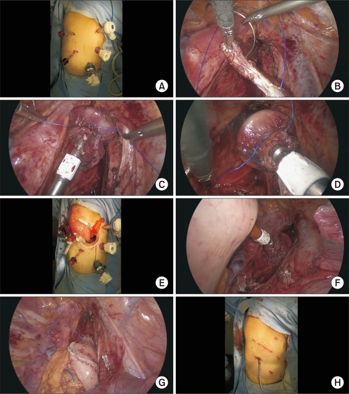 Intrathoracic anastomosis using handsewn purse-string suturing by the double-ligation method in laparo-thoracoscopic esophagectomy.