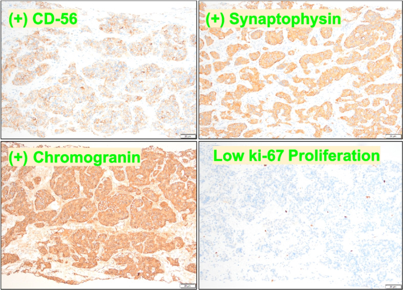 Late-stage diagnosis of carcinoid heart disease due to lack of access to health care.