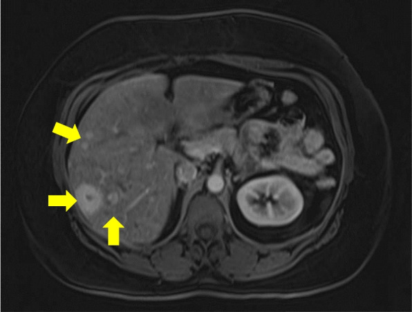 Late-stage diagnosis of carcinoid heart disease due to lack of access to health care.