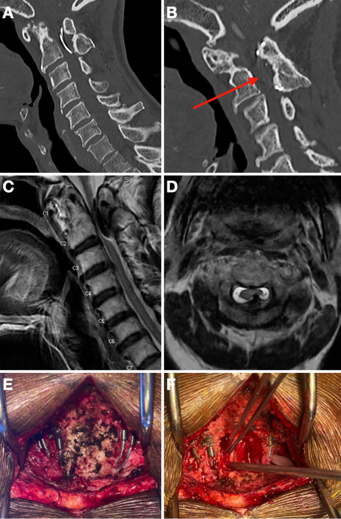 Delayed myelopathy after remote C1-2 sublaminar wire fixation: illustrative case.