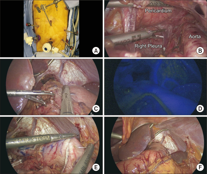 Intrathoracic anastomosis using handsewn purse-string suturing by the double-ligation method in laparo-thoracoscopic esophagectomy.