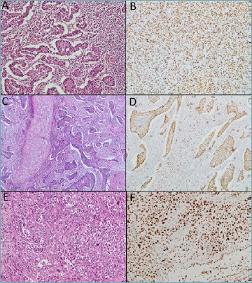 SMARCA4 as a support for the differential diagnosis of poorly differentiated lung carcinomas.