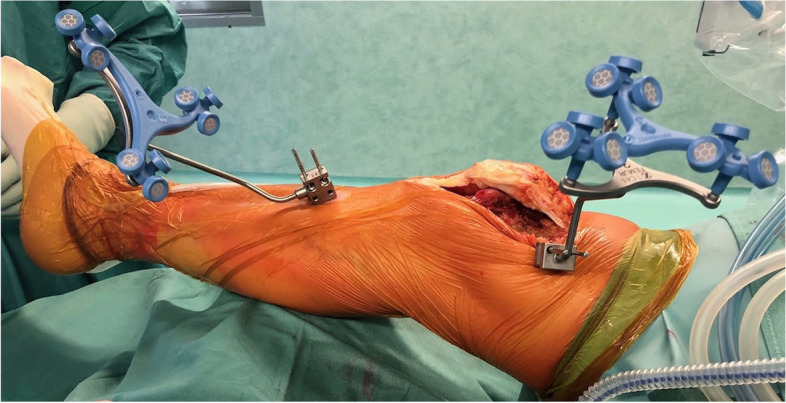 Biomechanical considerations for an easily-restricted robot-assisted kinematic alignment: a surgical technique note.