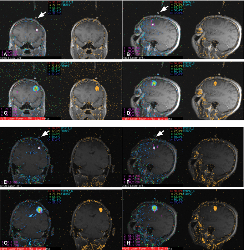 Stereotactic Radiosurgery as Treatment for Brain Metastases: An Update.