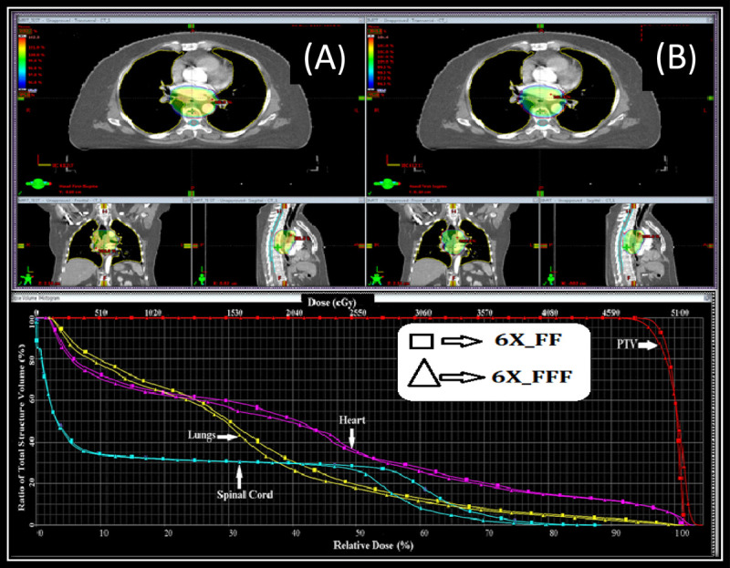 Assessment of Treatment Plan Quality between Flattening Filter and Flattening Filter Free Photon Beam for Carcinoma of the Esophagus with IMRT Technique.