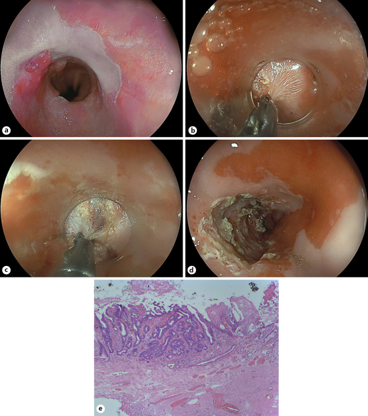 Direct Mucosal-Side Fibrosis Cutting for Salvage Endoscopic Submucosal Dissection of Secondary Barrett's Neoplasia Adjacent Multiband Resection Scars.