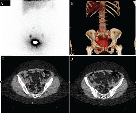 The Evaluation of Sentinel Lymph Node Biopsy Using Radiocolloid in First Stage Endometrial Cancer.