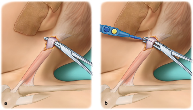 [Surgical treatment of congenital muscular torticollis].