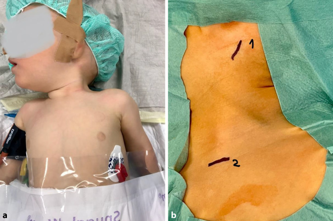 [Surgical treatment of congenital muscular torticollis].