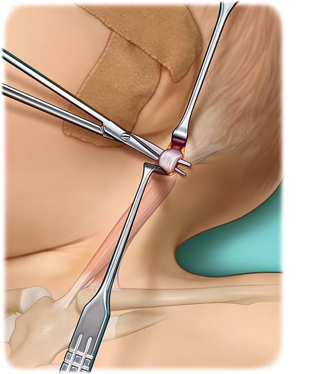 [Surgical treatment of congenital muscular torticollis].