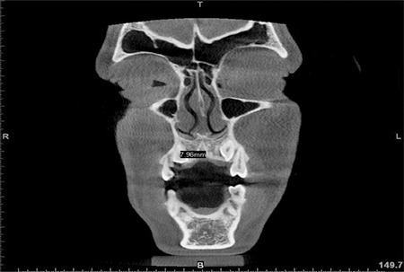 Accuracy of Cone-Beam Computed Tomography Software in Predicting the Size of Impacted Canine: A Preliminary Study.