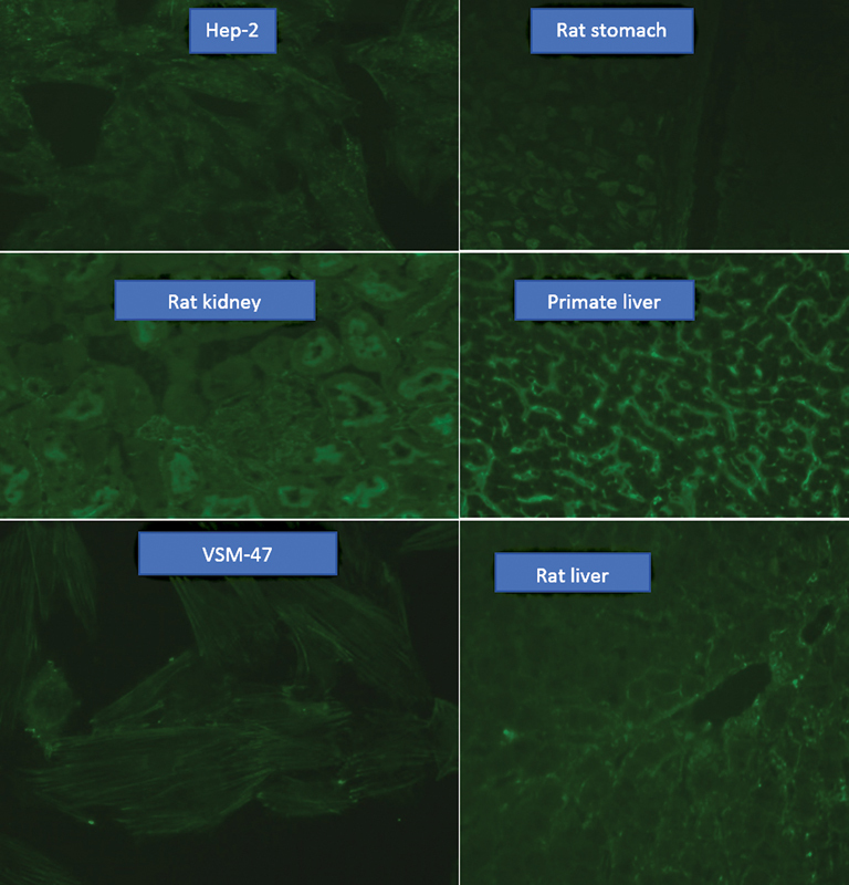 Anti-F-Actin Antibody Positivity on Indirect Immunofluorescence Assay Following Chinese and Alternative Medicine Therapy: A Case Report.