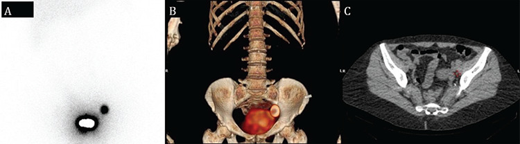 The Evaluation of Sentinel Lymph Node Biopsy Using Radiocolloid in First Stage Endometrial Cancer.