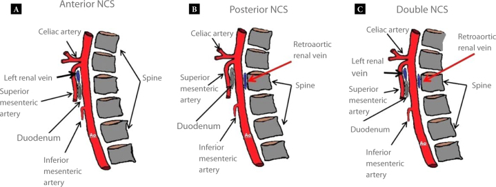 Double nutcracker syndrome in a patient with circumaortic venous ring: a rare case report.