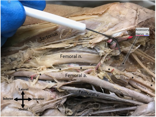 Atypical Origin of the Saphenous Nerve and a Variation of the Right Iliacus Muscle: A Case Report.