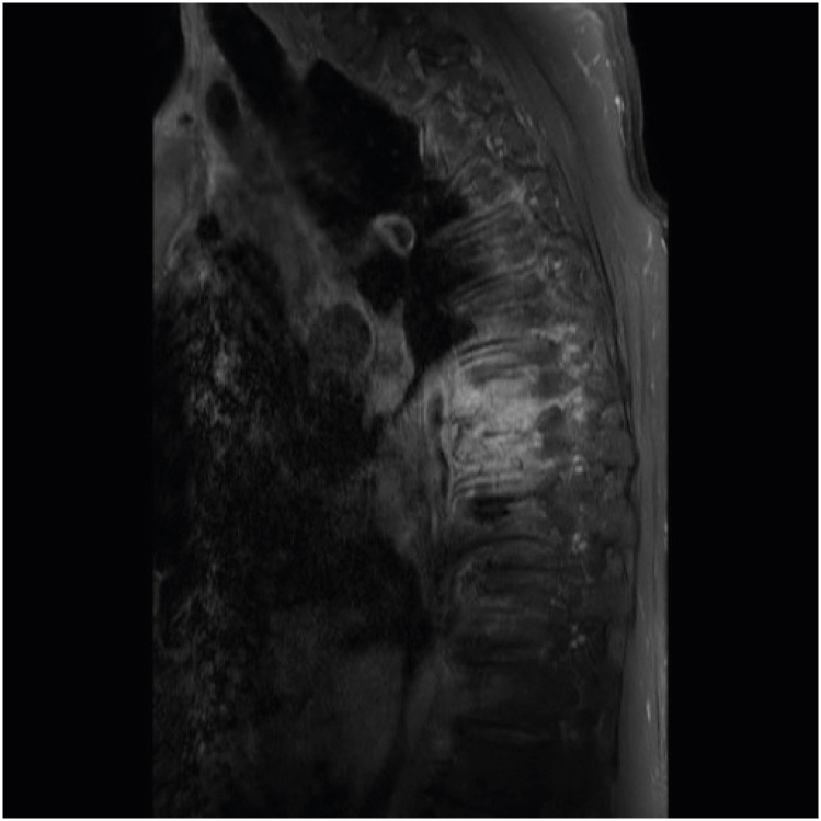 Infectious Spondylitis and Septicemia due to <i>Lactococcus garvieae</i>: a Literature Review of Non-Endocarditis Cases.