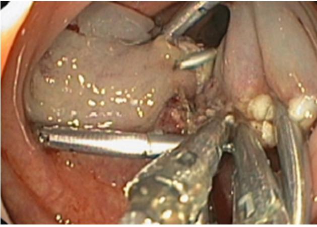 A case report of an unexpected colonic polyp: cavernous hemangioma.