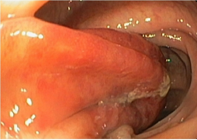 A case report of an unexpected colonic polyp: cavernous hemangioma.