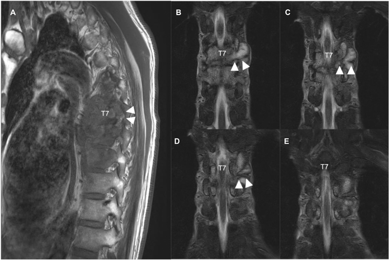 Bilateral Percutaneous Transpedicular Drainage under Local Anesthesia for Thoracic Tuberculous Spondylitis.