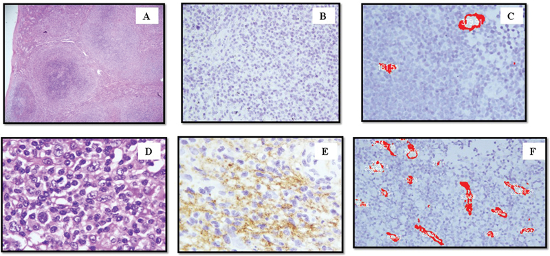 Histopathological Evaluation of Angiogenic Markers in Non-Hodgkin's Lymphoma.