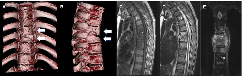 Bilateral Percutaneous Transpedicular Drainage under Local Anesthesia for Thoracic Tuberculous Spondylitis.