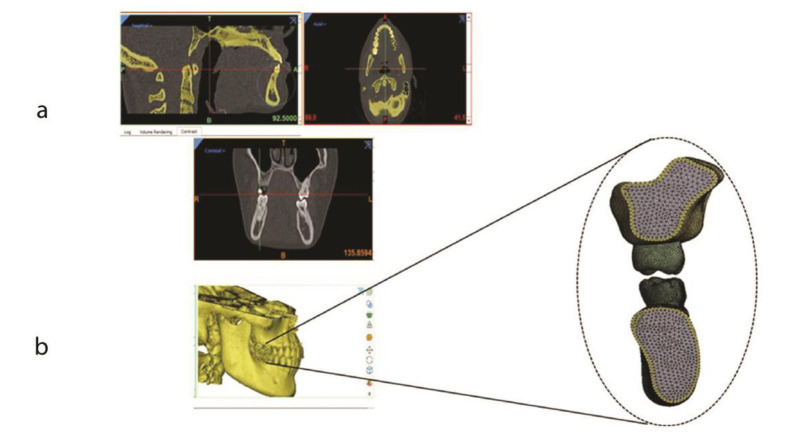 How Does the First Molar Root Location Affect the Critical Stress Pattern in the Periodontium? A Finite Element Analysis.