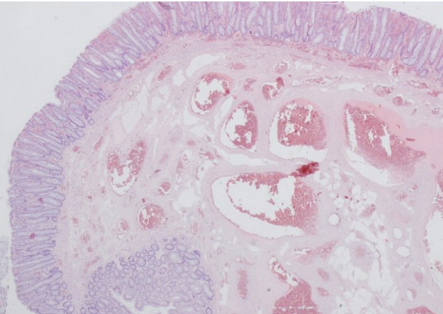 A case report of an unexpected colonic polyp: cavernous hemangioma.