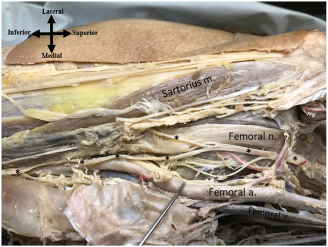 Atypical Origin of the Saphenous Nerve and a Variation of the Right Iliacus Muscle: A Case Report.