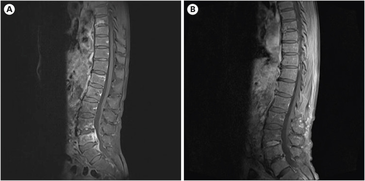 Infectious Spondylitis and Septicemia due to <i>Lactococcus garvieae</i>: a Literature Review of Non-Endocarditis Cases.