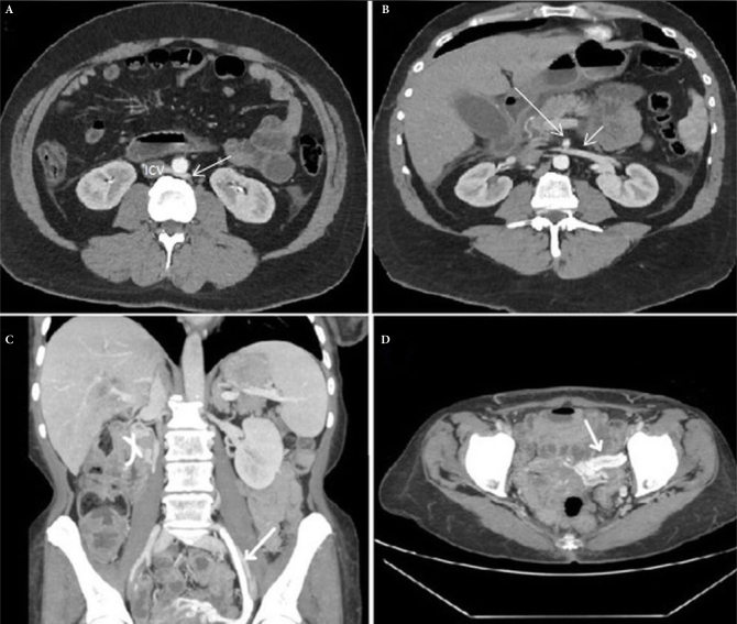 Double nutcracker syndrome in a patient with circumaortic venous ring: a rare case report.