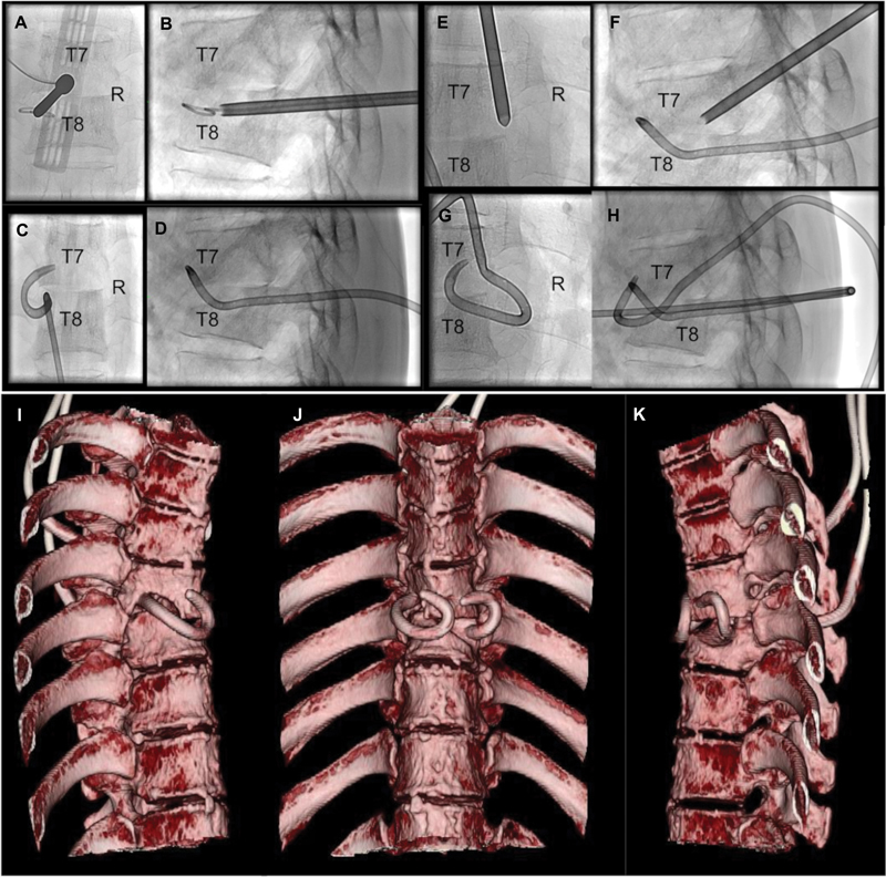 Bilateral Percutaneous Transpedicular Drainage under Local Anesthesia for Thoracic Tuberculous Spondylitis.