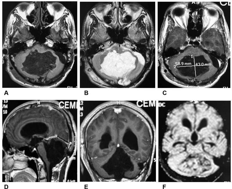 Supratentorial Intracerebral Hematoma as a Rare Complication of Posterior Fossa Surgery in Prone Position: A Case Report with Review of Literature.