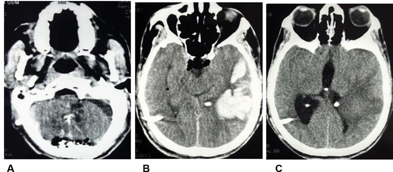 Supratentorial Intracerebral Hematoma as a Rare Complication of Posterior Fossa Surgery in Prone Position: A Case Report with Review of Literature.