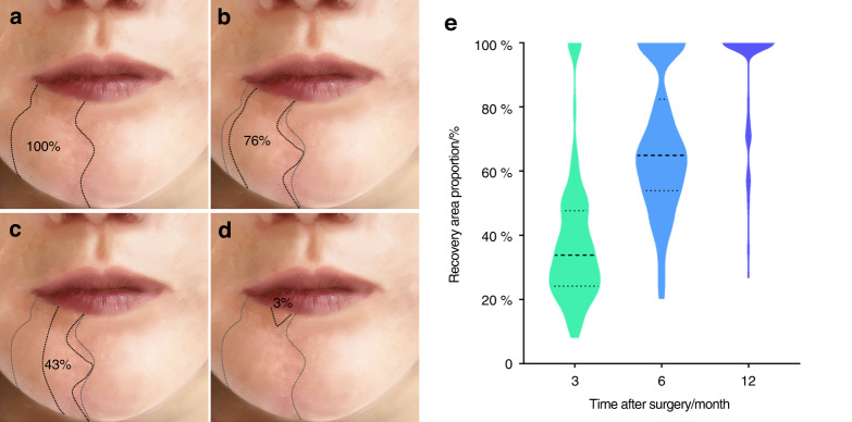 Promotion effect of TGF-β-Zfp423-ApoD pathway on lip sensory recovery after nerve sacrifice caused by nerve collateral compensation.