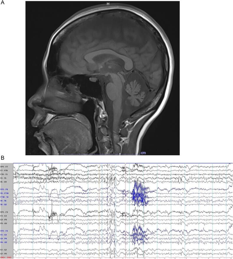 Spinocerebellar Ataxia type 17 presenting with progressive myoclonic epilepsy