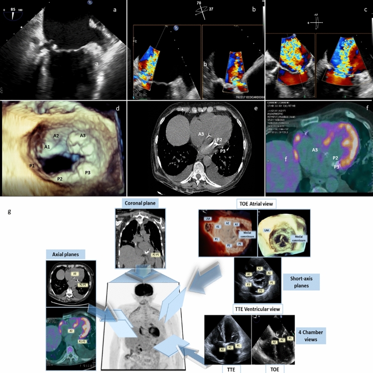 Non-invasive imaging of ventricular-atrial fistulization secondary to infective rupture of caseous calcification of the mitral annulus.