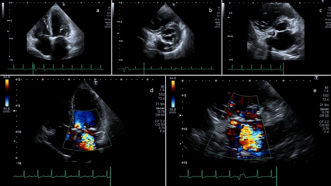 Non-invasive imaging of ventricular-atrial fistulization secondary to infective rupture of caseous calcification of the mitral annulus.