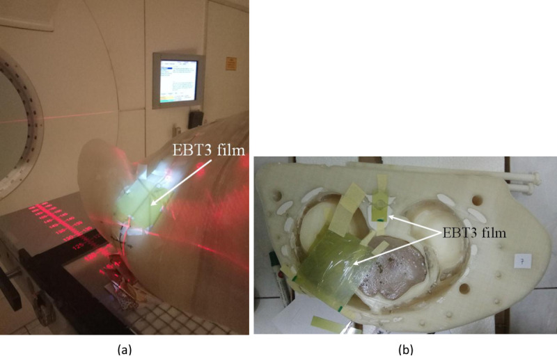 Dosimetry Evaluation of Treatment Planning Systems in Patient-Specific 3D Printed Anthropomorphic Phantom for Breast Cancer after Mastectomy using a Single-Beam 3D-CRT Technique for Megavoltage Electron Radiation Therapy.