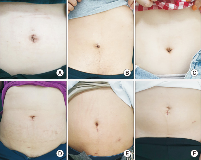 A prospective randomized controlled study comparing patient-reported scar evaluation of single-port versus multiport laparoscopic appendectomy for acute appendicitis.