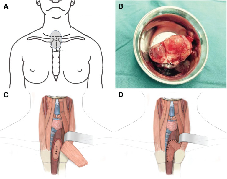 Reconstruction of the Esophagus with Sternohyoid Flap after Resection of a Large Cervical Esophageal Leiomyosarcoma.