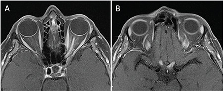 Late-Onset Neuromyelitis Optica Spectrum Disorder Mimicking a Non-Arteritic Anterior Ischemic Optic Neuropathy-Case Report.