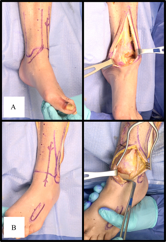 Pilon fractures: Consensus and controversy.