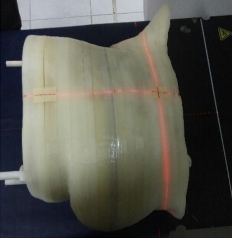 Dosimetry Evaluation of Treatment Planning Systems in Patient-Specific 3D Printed Anthropomorphic Phantom for Breast Cancer after Mastectomy using a Single-Beam 3D-CRT Technique for Megavoltage Electron Radiation Therapy.