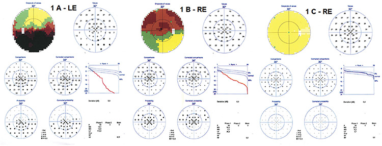 Late-Onset Neuromyelitis Optica Spectrum Disorder Mimicking a Non-Arteritic Anterior Ischemic Optic Neuropathy-Case Report.